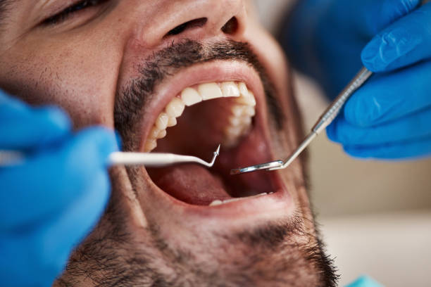 Best Emergency Dentist for Lost Fillings or Crowns in Slidell, LA